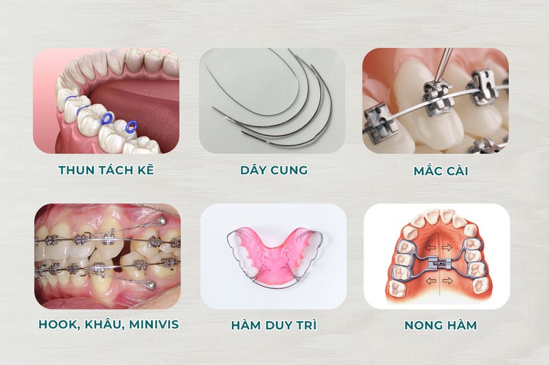 Vật liệu, khí cụ niềng có nguồn gốc xuất xứ chính hãng 100%