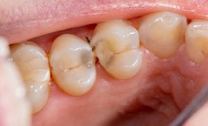Bệnh lý sâu răng diễn ra khá phổ biến
