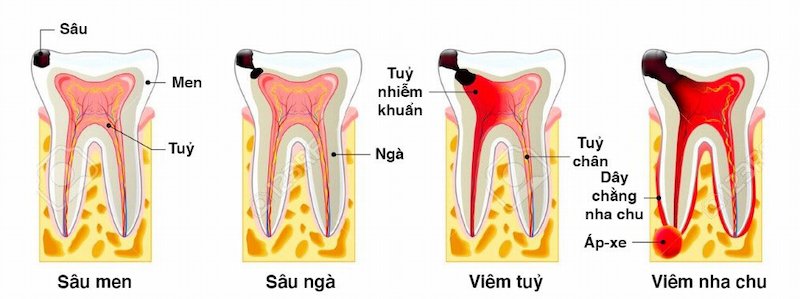 Quá trình sâu răng gồm 4 giai đoạn