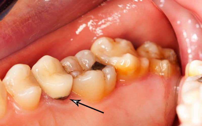 Sâu răng rất dễ lây lan từ tuyến nước bọt