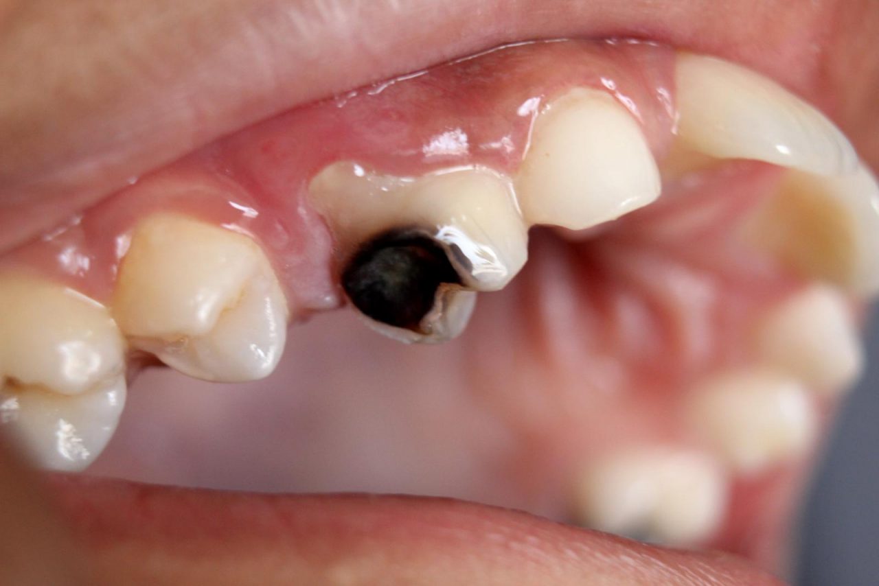 Sâu răng ăn vào tủy ở trẻ em
