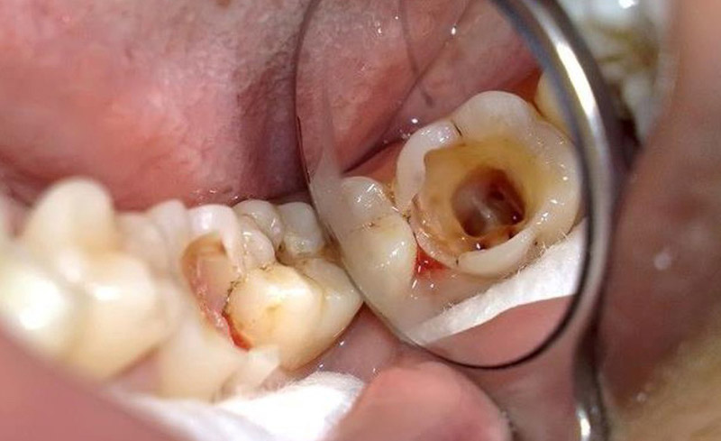 Răng sâu ăn vào tủy ở trẻ nhỏ