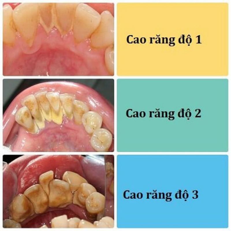 Cao răng sẽ hình thành theo từng giai đoạn khác nhau