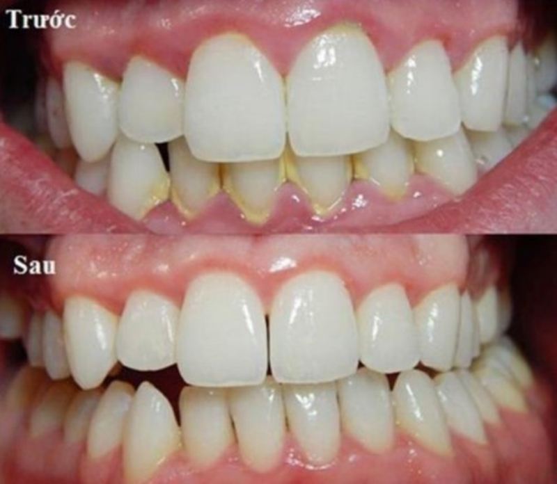 Cạo vôi răng định kỳ sẽ giúp hạn chế tình trạng cạo vôi răng bị ê buốt 