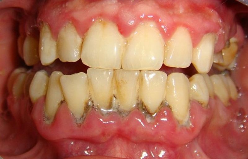 Vôi răng hình thành làm mất thẩm mỹ cho răng miệng