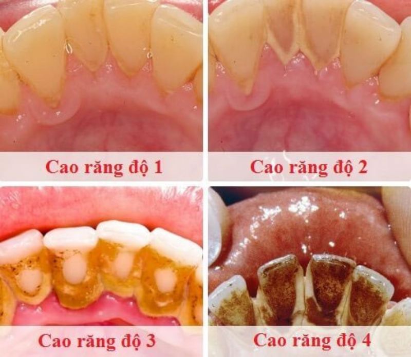 4 cấp độ vôi răng phổ biến hiện nay