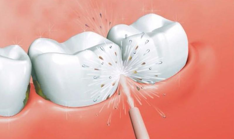 Cạo vôi răng bằng sóng siêu âm là phương pháp điều trị hiệu quả