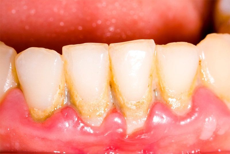 Vôi răng là một trong những vấn đề răng miệng phổ biến
