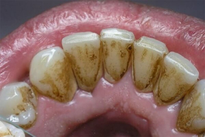 Vôi răng chính là bệnh lý phổ biến mà nhiều người mắc phải