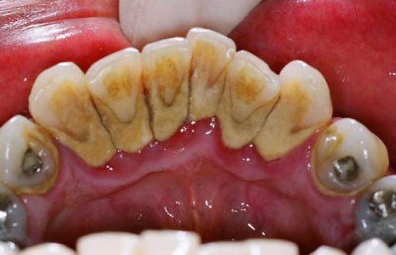 Vôi răng được hình thành từ khoáng chất lắng đọng từ thức ăn thừa và nước bọt