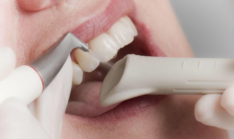 Cạo vôi răng bằng sóng siêu âm giúp điều trị dứt điểm hôi miệng