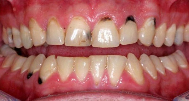 Chân răng bị đen là một trong những dấu hiệu của răng sâu