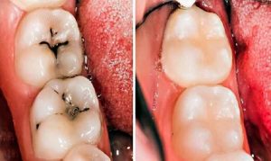 Trám sứ là giải pháp hiệu quả khắc phục răng sâu bị đen