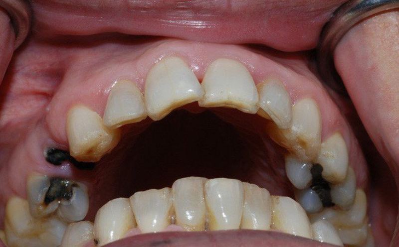 Răng sâu bị đen không được điều trị sẽ làm mất răng vĩnh viễn