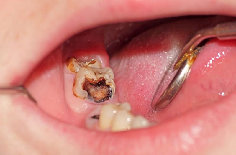 Răng sâu lồi thịt là tình trạng răng sâu ở giai đoạn nặng