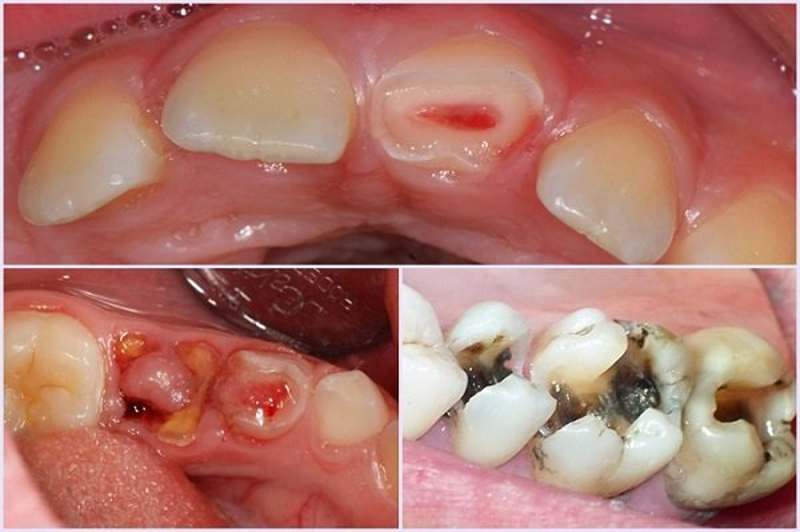 Nhiều tác hại to lớn từ răng sâu lồi thịt gây ra