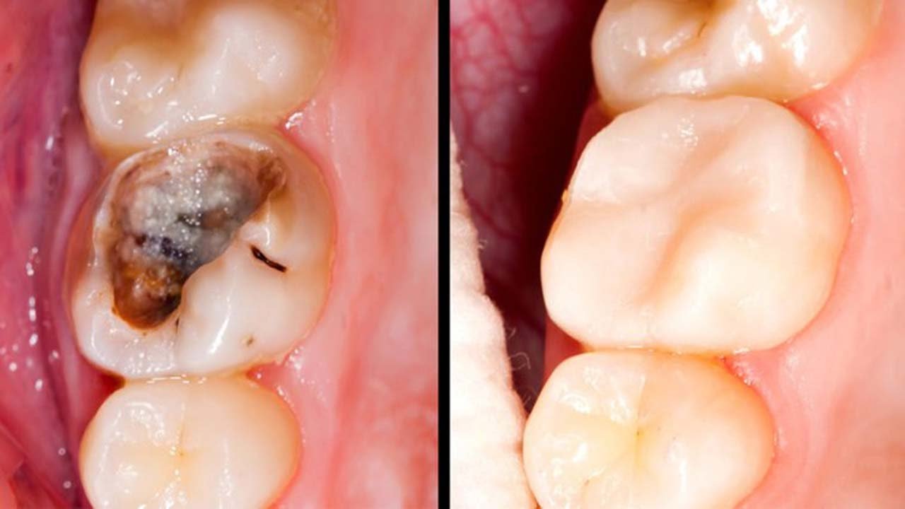 Sâu răng là một trong những bệnh lý phổ biến ở nhiều lứa tuổi