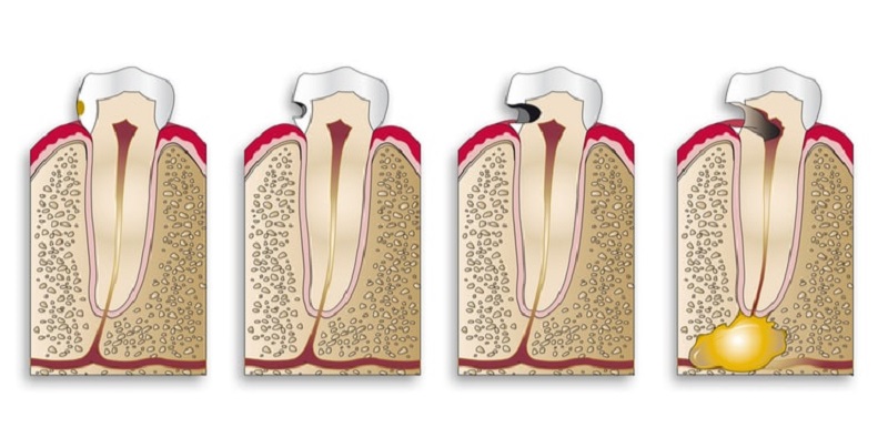 Quá trình phát triển và xâm lấn của vi khuẩn sâu răng