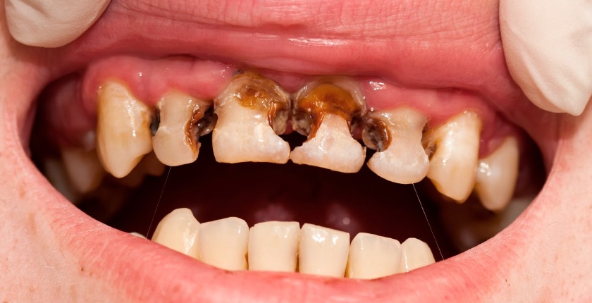 Sâu răng gây ra nhiều hệ lụy cho sức khỏe răng miệng