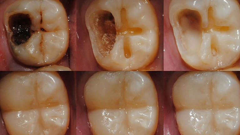 Loại bỏ ổ sâu răng và trám sứ cho răng sâu ở mức độ 2