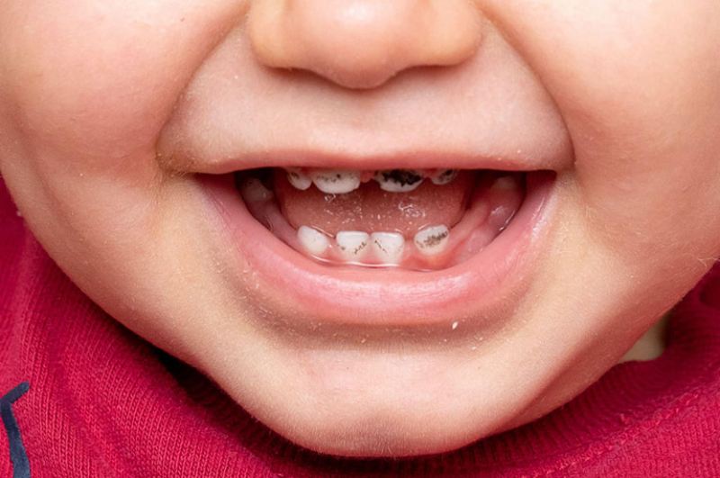 Trẻ nhỏ dưới 12 tháng tuổi dễ bị sâu răng tấn công